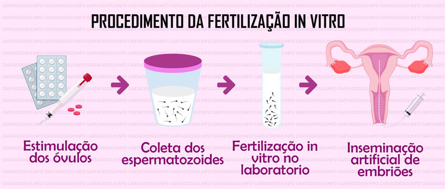 passo a passo de uma fertilização in vitro