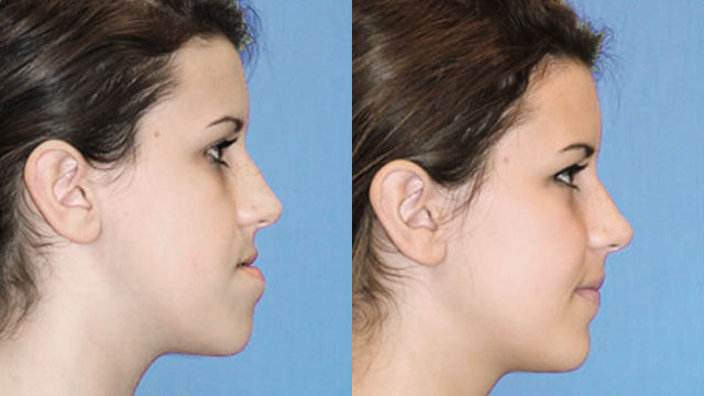 cirurgia ortognatica antes e depois